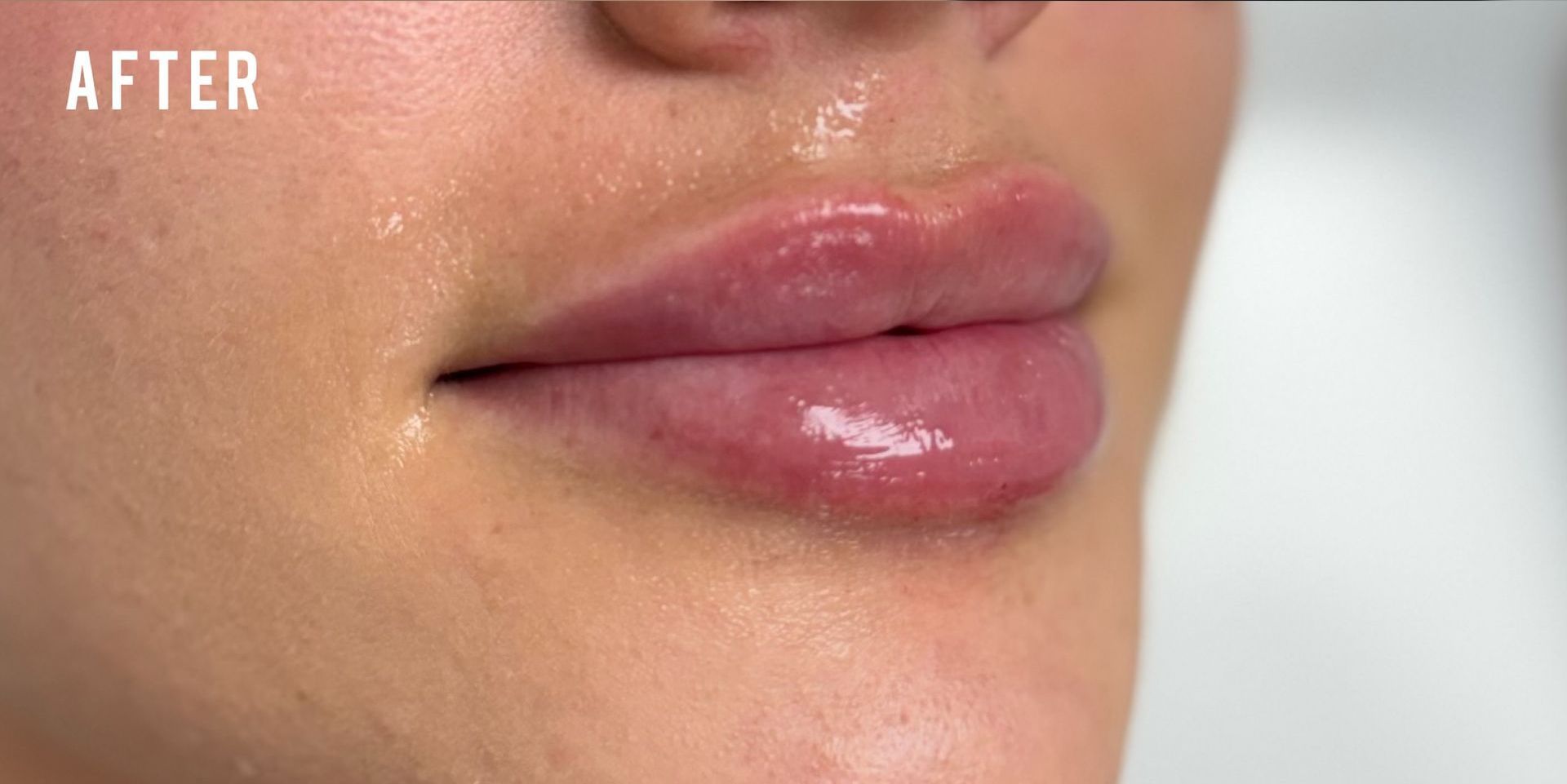 A close-up view of a person's lips after a filler procedure, showing a glossy, smooth, and fuller appearance.