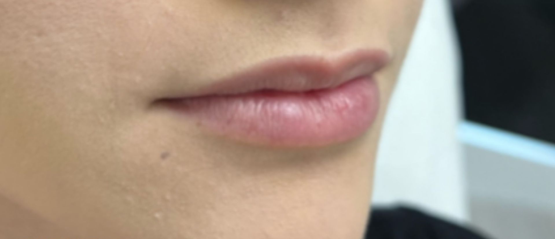 Close-up of lips before lip filler.