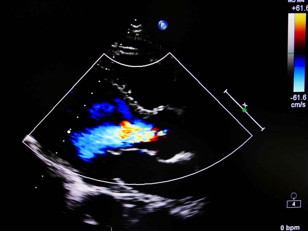 diagnostica con ecocolordoppler