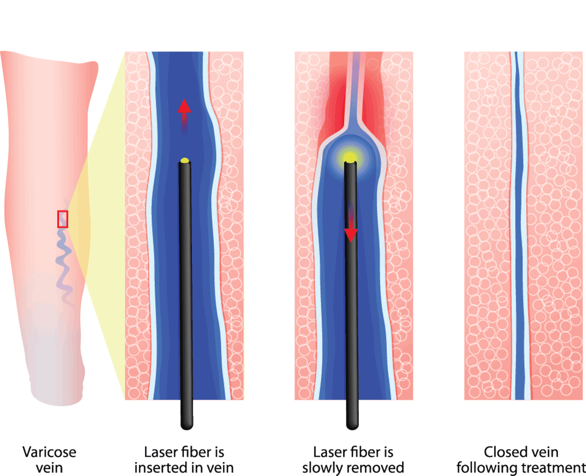 raffigurazione dei principi della laserterapia