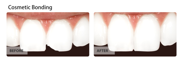 Cosmetic dental bonding before and after: a chipped tooth is repaired, and the smile is improved.