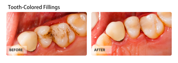 Side-by-side dental photos showing teeth with cavities