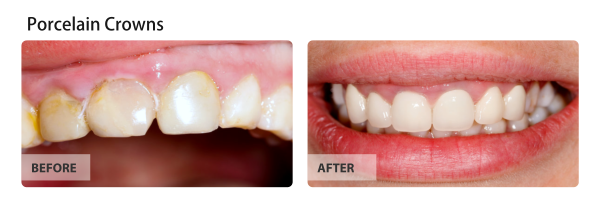 Before and after of teeth. The