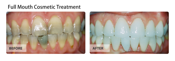 Side-by-side comparison of teeth, before and after a full mouth cosmetic treatment. Before: yellow teeth. After: white teeth.