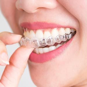 Person biting a clear dental aligner over their teeth