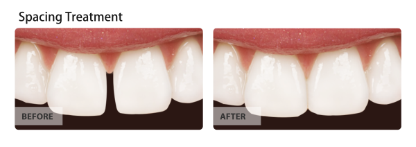 Comparison of teeth: before and after spacing treatment. Before shows a gap, after shows teeth closely aligned.
