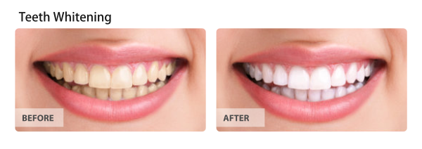 Teeth whitening comparison: before and after. Yellow teeth on the left, white teeth on the right.