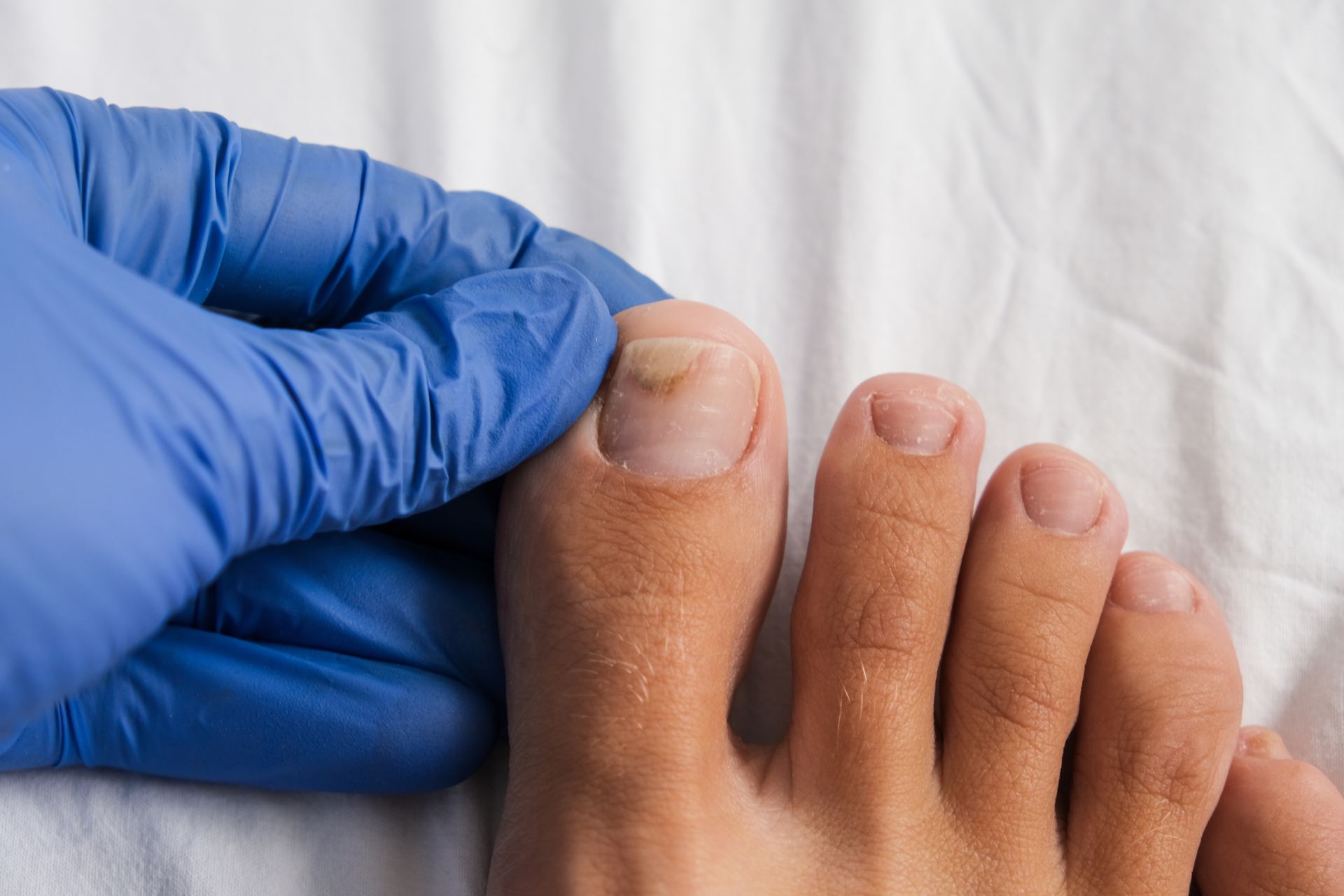 Gloved hand examining a swollen big toe with a yellowed nail on a foot