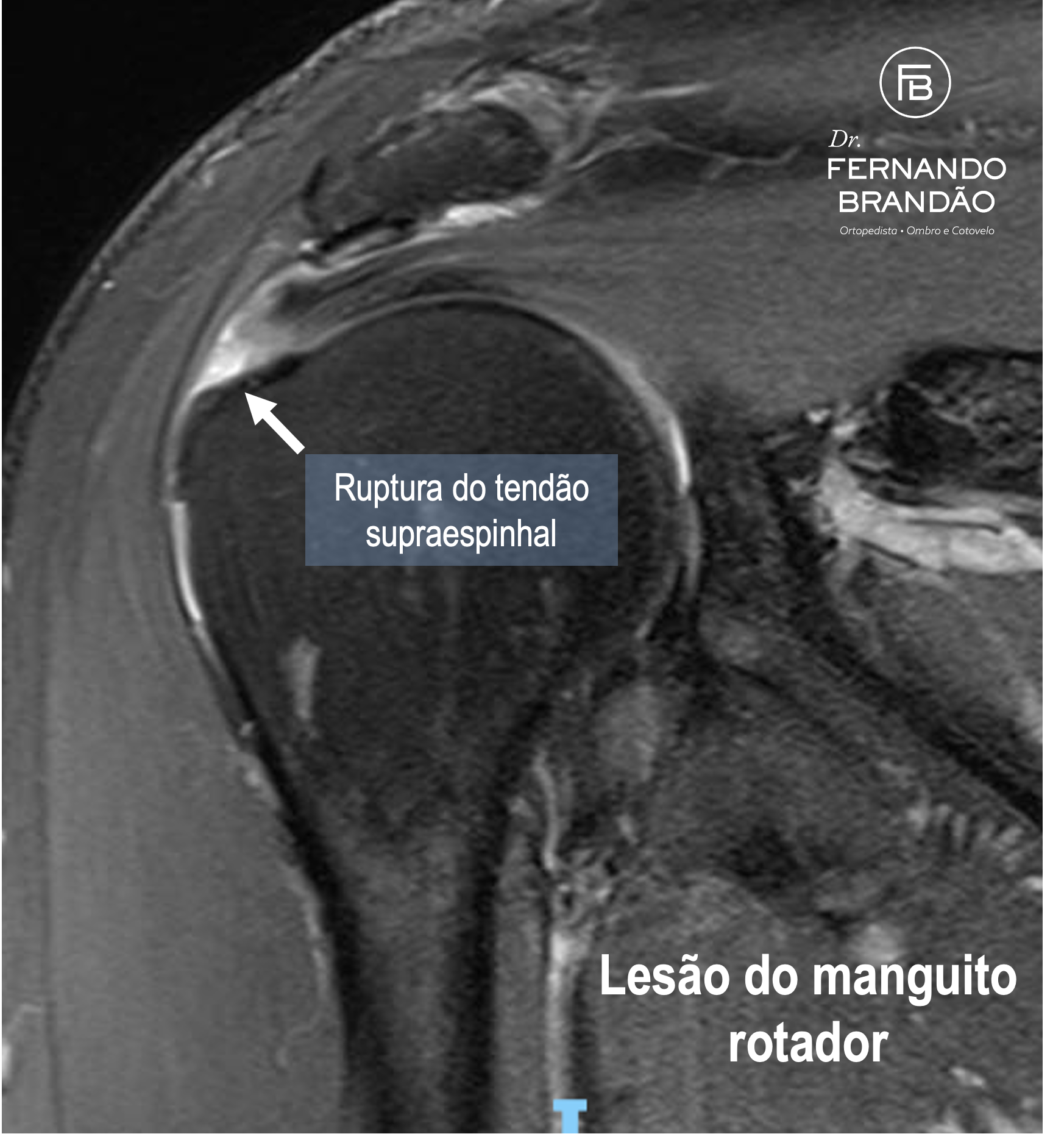 Ressonancia magnetica com lesão do manguito rotador