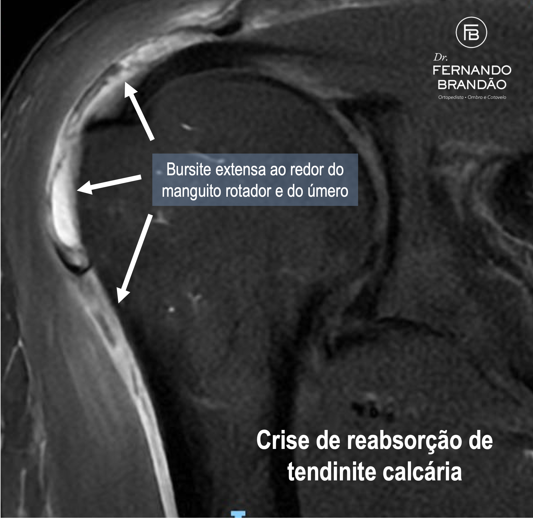 Ressonancia magnetica do ombro com bursite causada por tendinite calcaria do manguito rotador