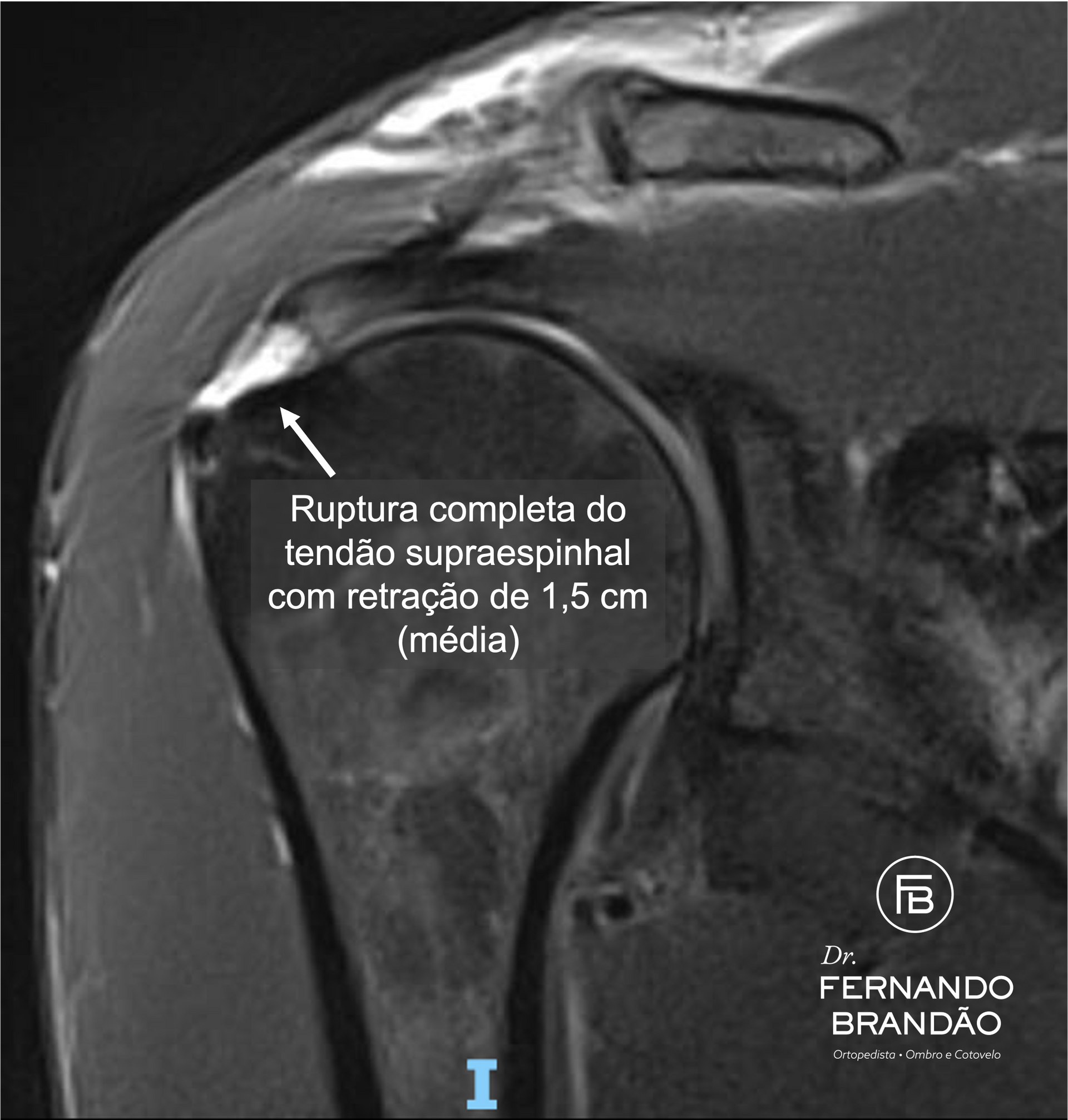 Ruptura do tendão supraespinhal - manguito rotador