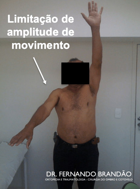 Limitação de movimento no ombro congelado - capsulite adesiva