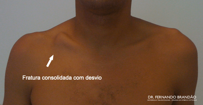 Imagem demonstra aspecto do ombro com fratura da clavícula consolidada com desvio ósseo, consolidação viciosa