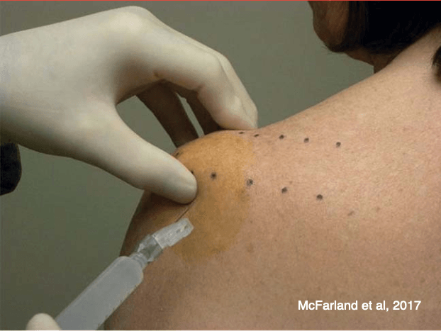 Infiltração do ombro com corticóide (corticosteróide) para o tratamento de bursite e tendinite do manguito rotador