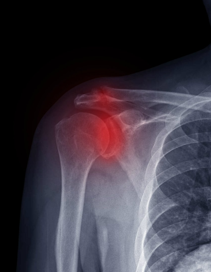 Luxação Acromioclavicular