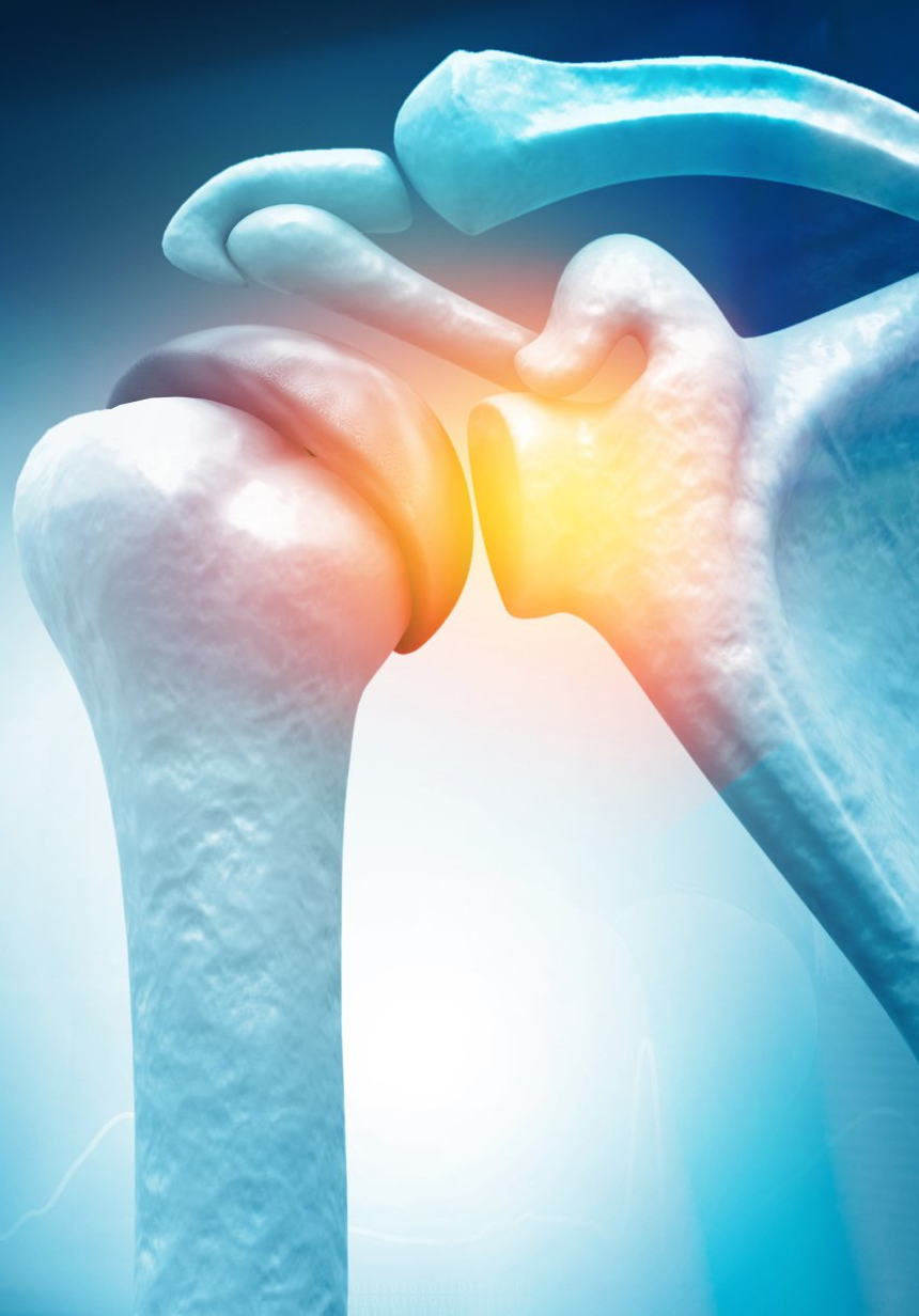 Osteoartrose do Ombro