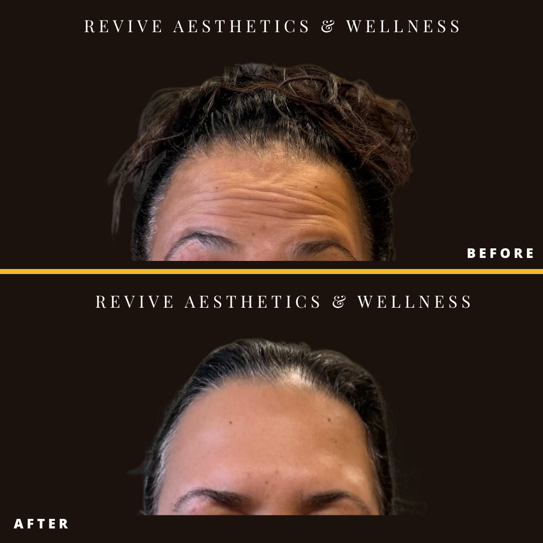 wrinkle relaxer, botox, xeomin, dysport, neuromodulators