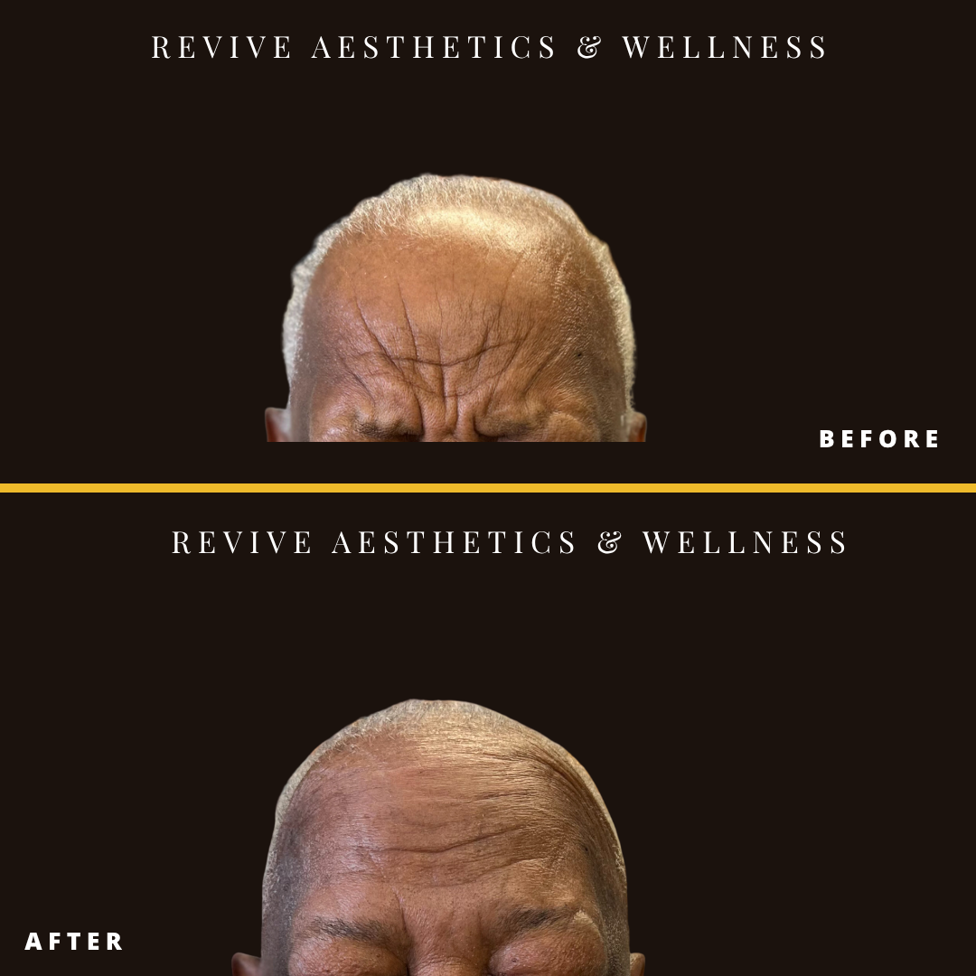 wrinkle relaxer, wrinkle help, senior botox, xeomin, dysport