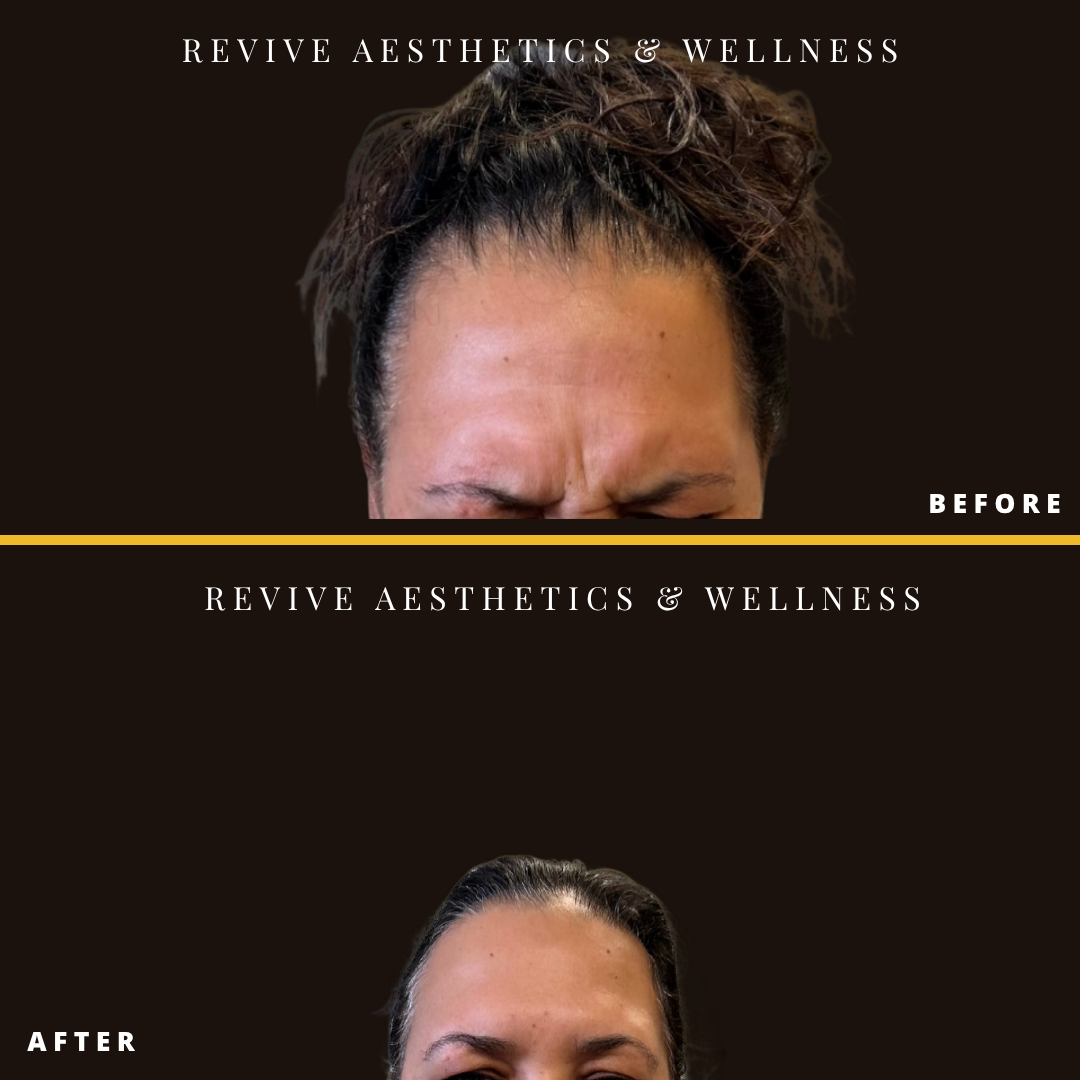 wrinkle relaxer, xeomin, dysport, neuromodulator