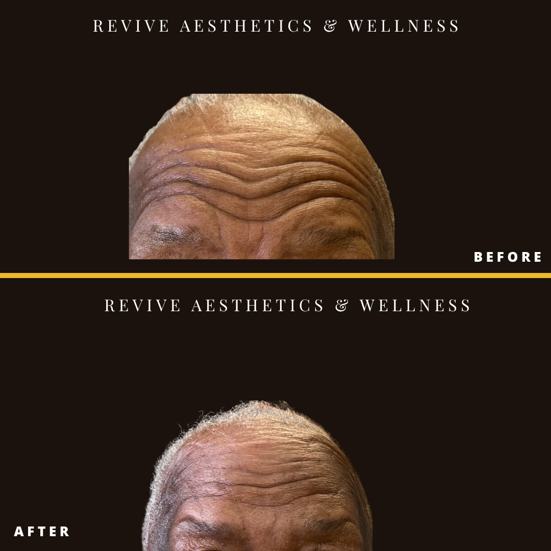 botox, neuromodulators, wrinkle relaxer, aging skin, wrinkle help
