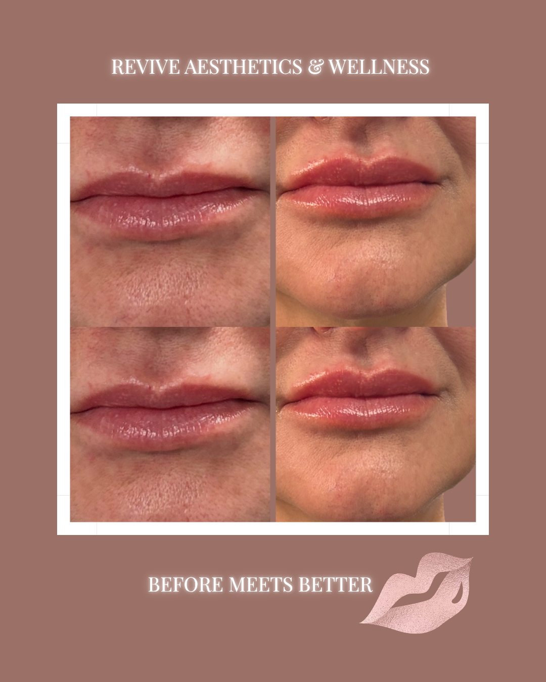 Lip filler, Hyaluronic Acid