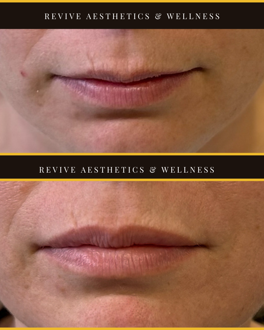 lip filler, hyaluronic acid, natural lip filler, soft subtle lips, natural lips
