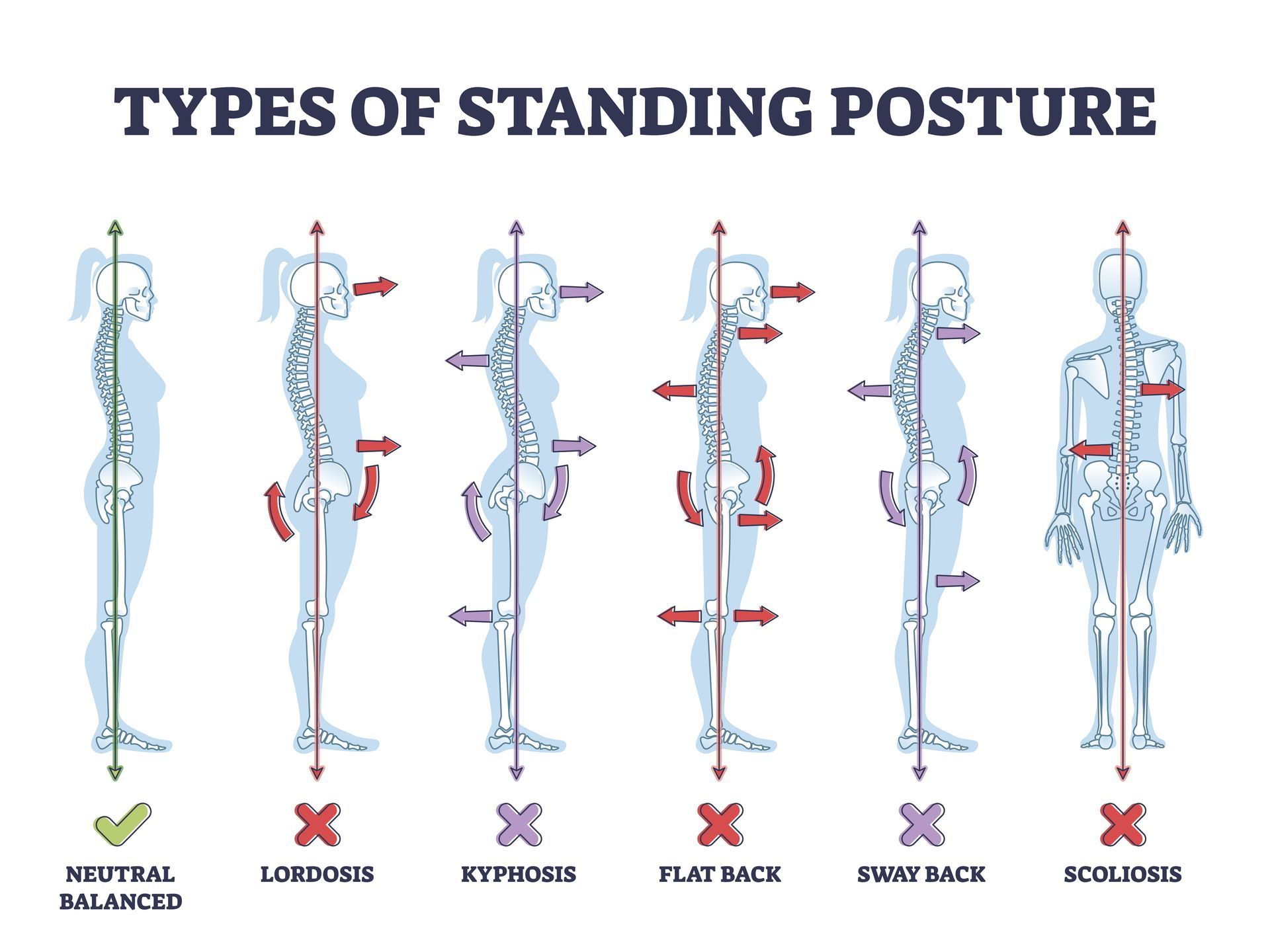 Diagram of six standing posture types with skeletal figures and red highlights for poor alignment