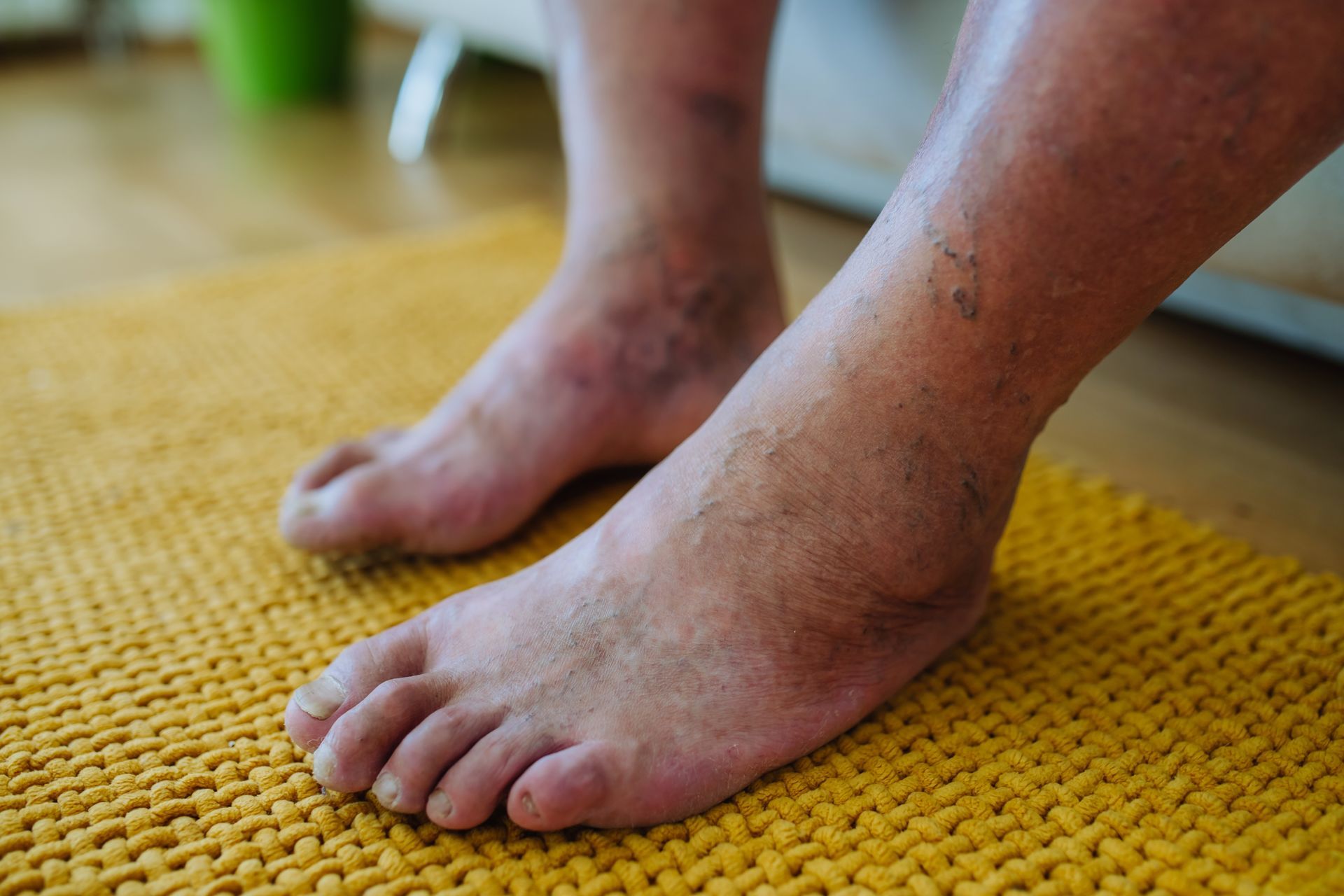 Feet and lower legs with visible swelling and discoloration, resting on a yellow rug.