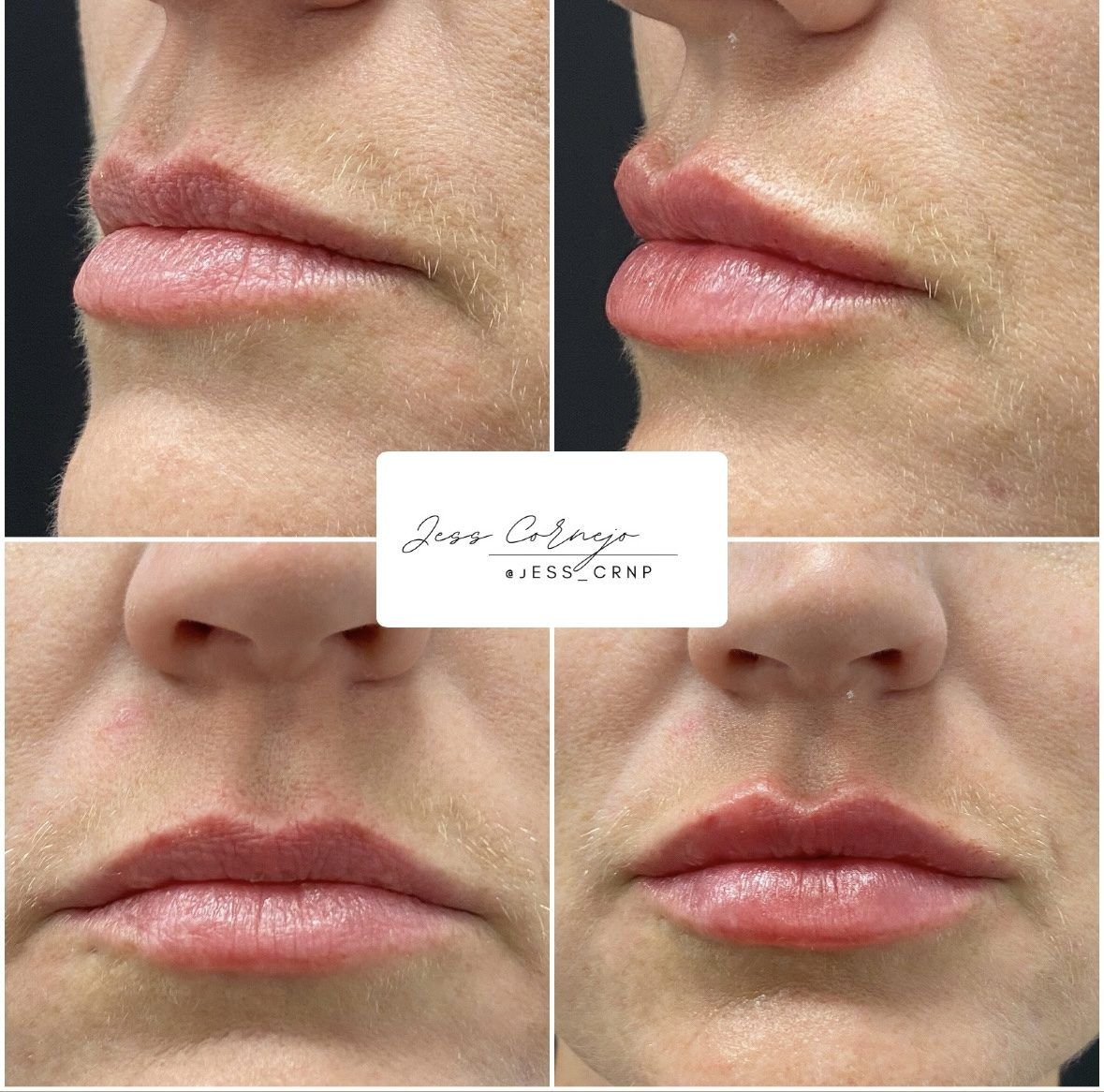 Four close-up lip photos showing before-and-after cosmetic enhancement with fuller, glossier pink lips.