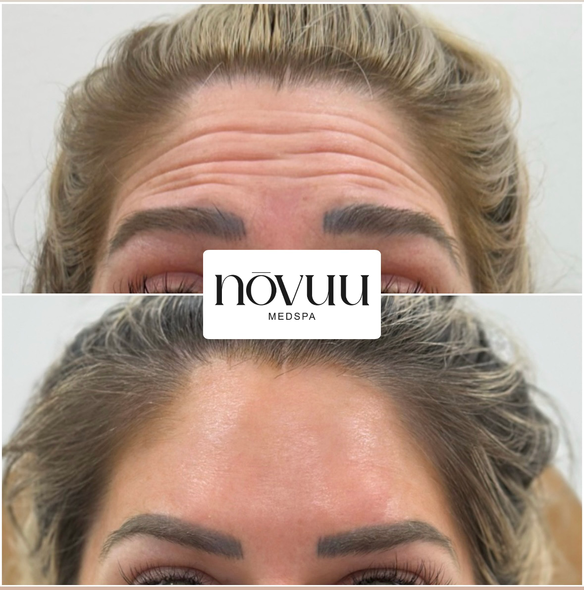Forehead before-and-after comparison showing smoother skin and reduced wrinkles
