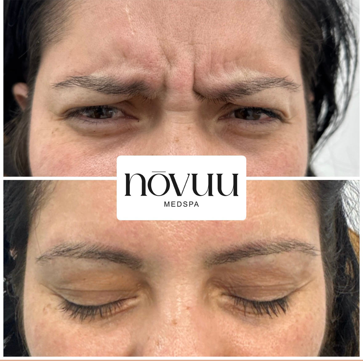 Before-and-after close-up of a forehead, showing wrinkles before and smoother skin after treatment