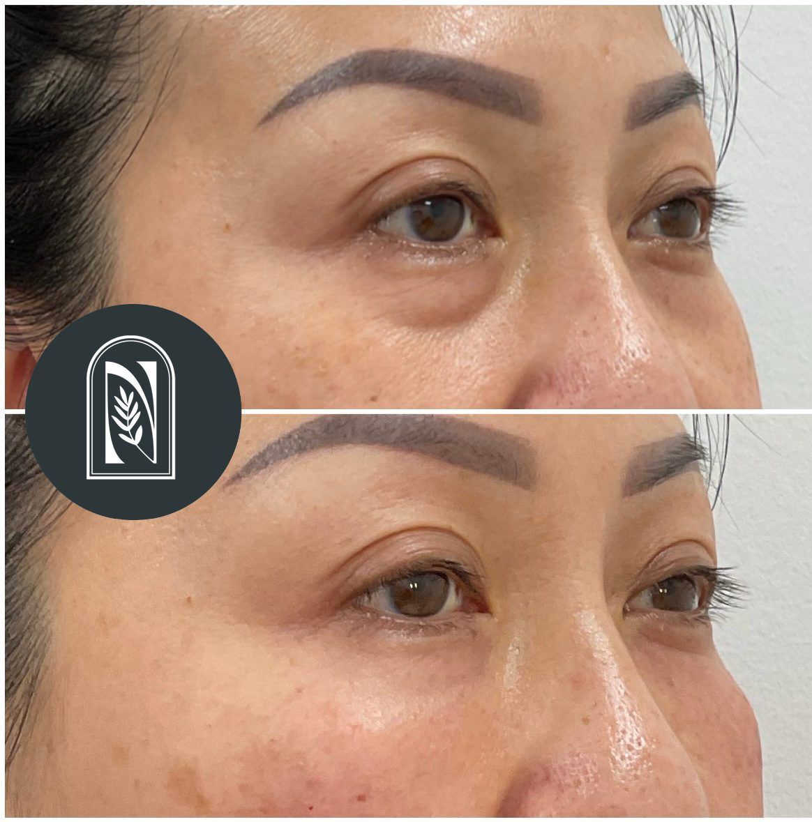 Close-up before-and-after of eyebrows and under-eye area, showing smoother skin and lifted brows.