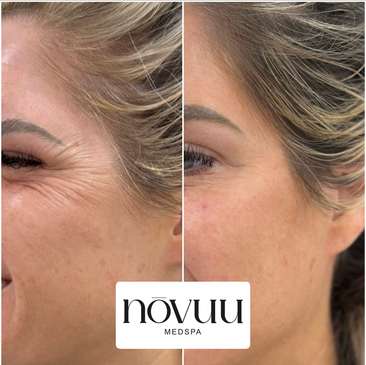 Side-by-side close-up of cheek and eye wrinkles before and after treatment, with Novuu Medspa logo.
