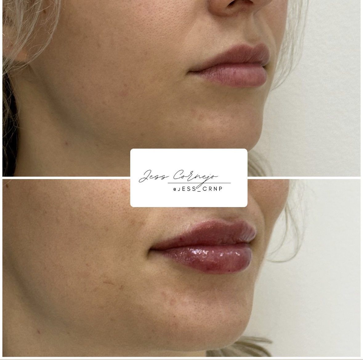 Side-by-side close-up of lips before and after cosmetic treatment, with fuller, glossier lips in the lower image