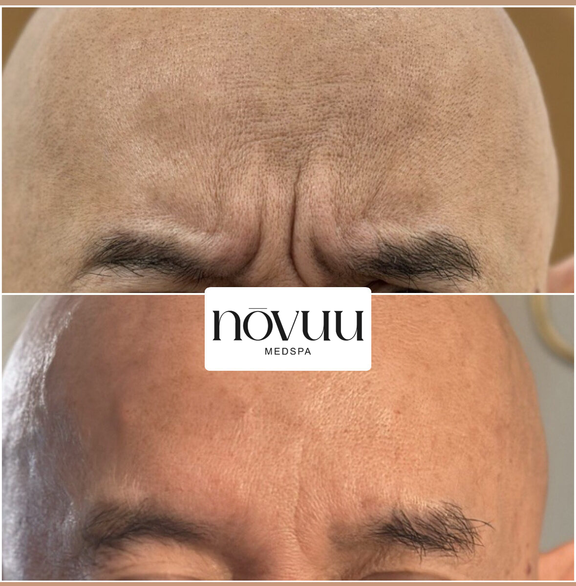 Before-and-after close-up of forehead wrinkles, with a centered logo between the two images.