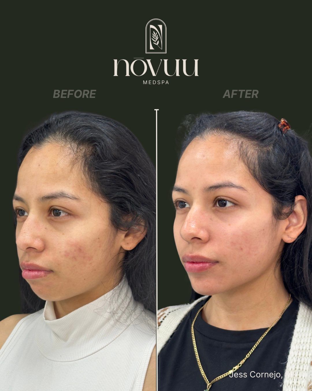 Before-and-after portrait of a woman showing facial profile changes, with split-screen labels.