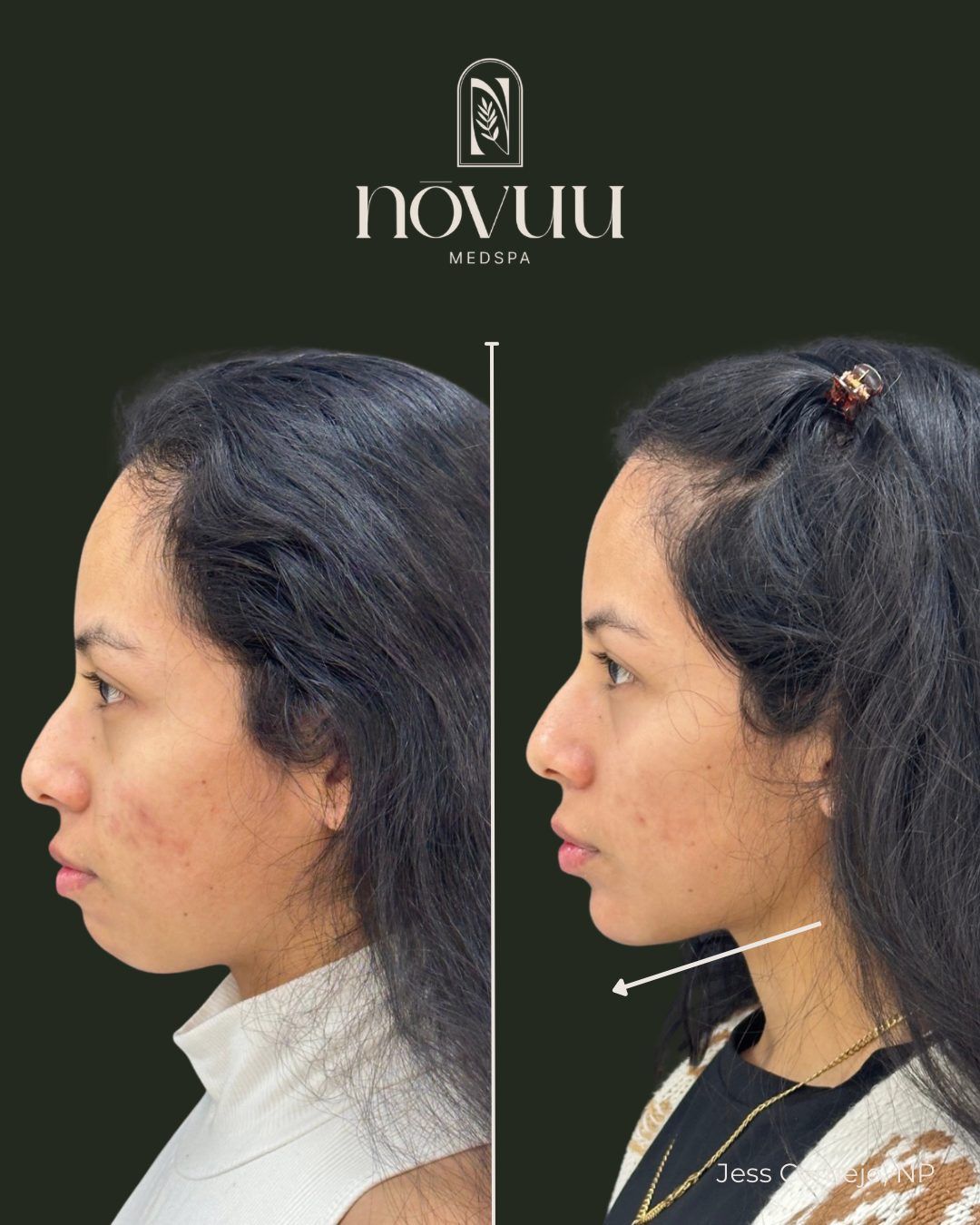 Side-by-side profile photos of a woman before and after neck and chin contouring treatment.