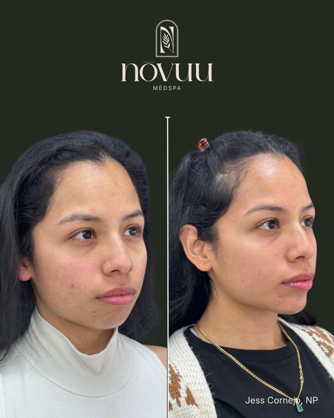 Side-by-side before-and-after profile photos of a person with a nose bridge and tip change.