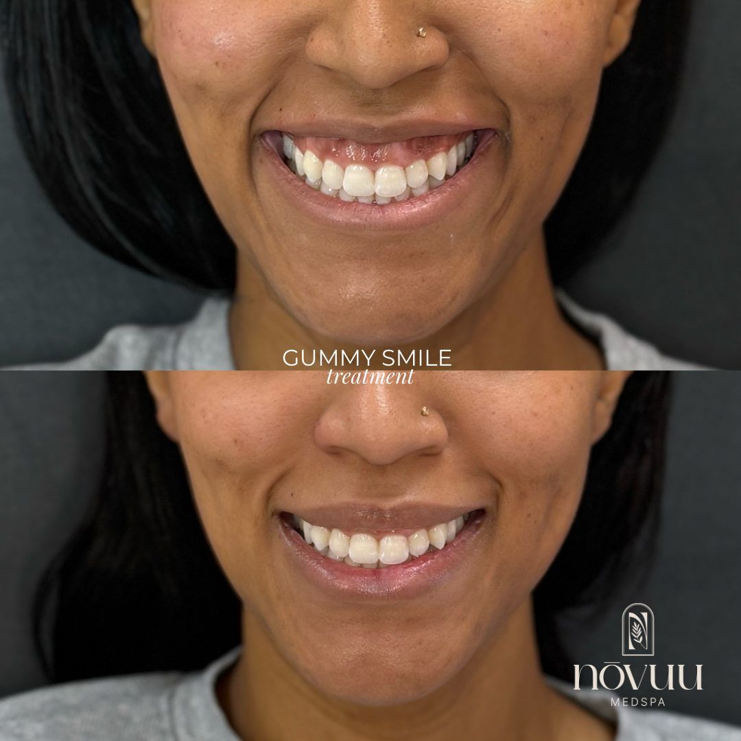 Before-and-after smile close-up showing dental whitening results