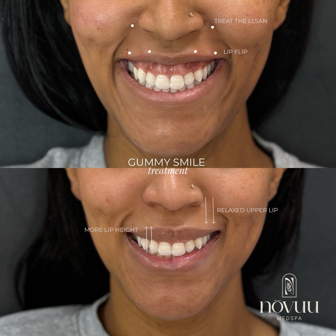 Before-and-after close-up of a smiling mouth showing teeth alignment correction