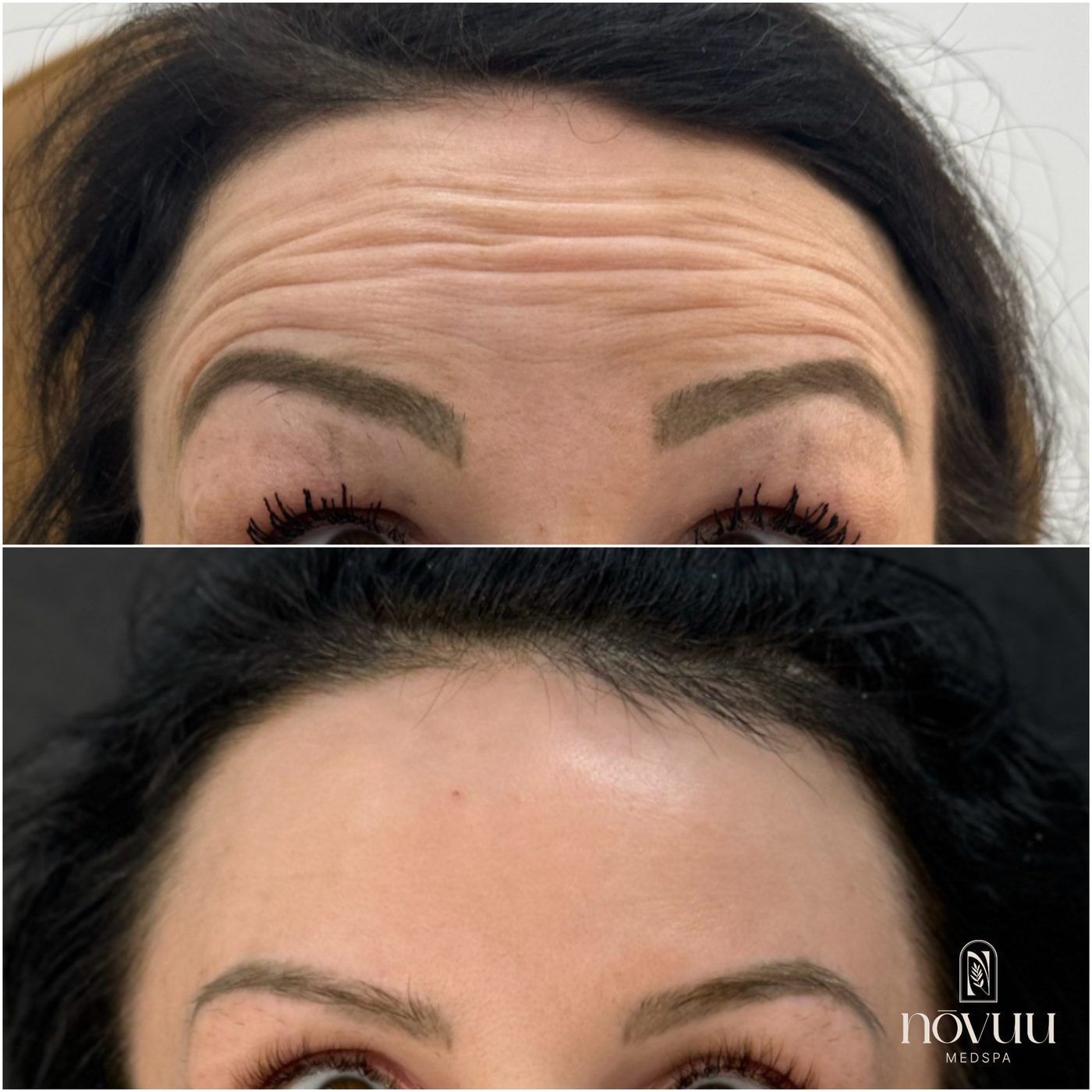 Forehead before-and-after view showing fewer wrinkles in the lower image