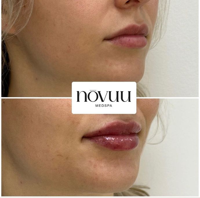 Before-and-after close-up of a woman's lips, showing fuller, glossier lips in the lower image.