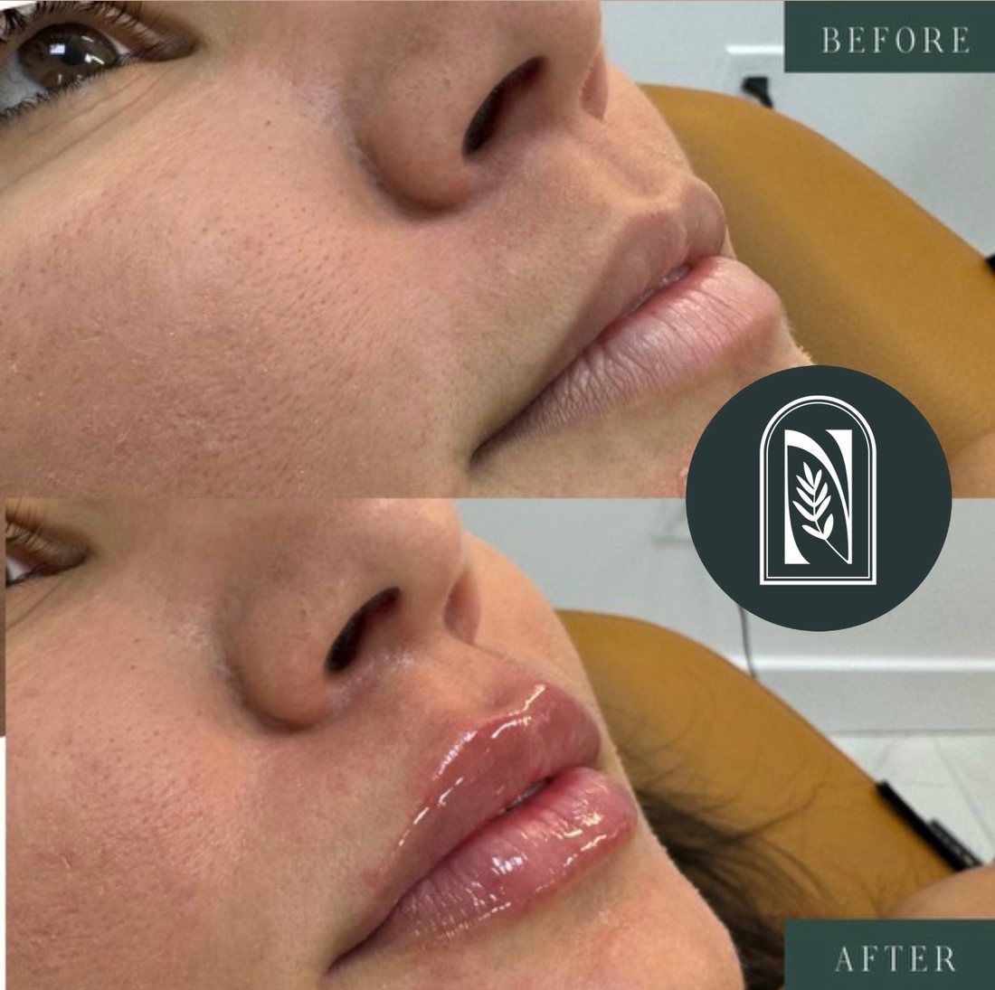 Before-and-after close-up of lips, with glossy fuller lips in the after image.