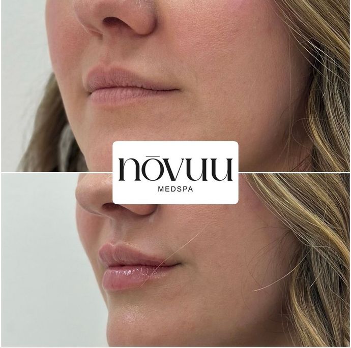Before-and-after close-up of a woman’s lower face and lips with a Novuu Medspa logo overlay