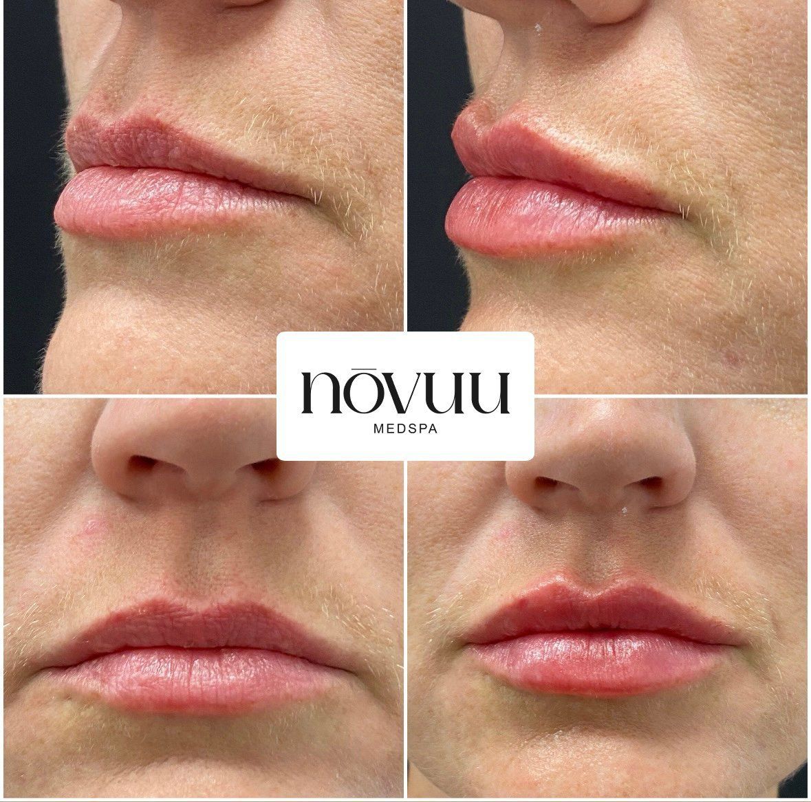 Before-and-after collage of lip filler results with close-up lips and a central logo.