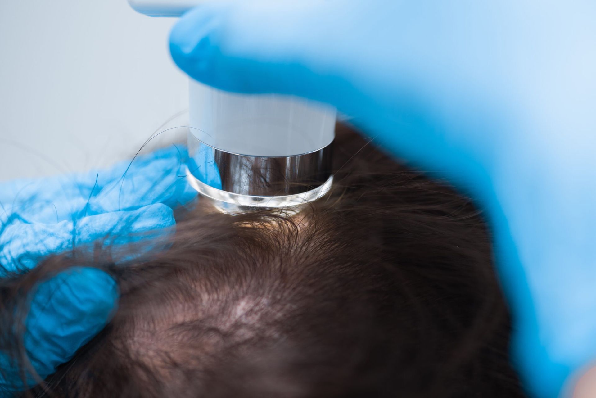 Blue-gloved hands examining a scalp with a dermatoscope close-up