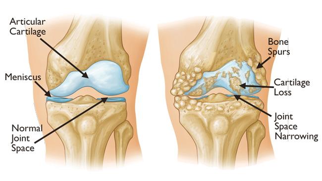 A diagram of a normal knee joint and a knee joint with cartilage loss