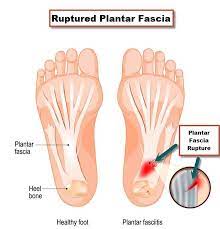 A diagram of a ruptured plantar fascia and a healthy foot.