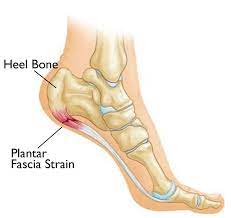 A diagram of a foot with a heel bone and plantar fascia strain.