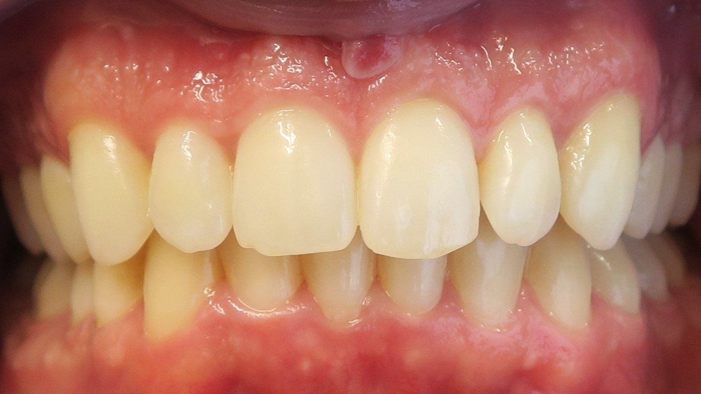Before and after image of smile